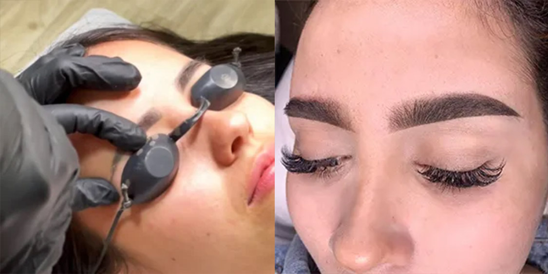 Técnicas de remoción