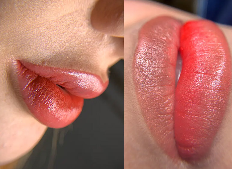 Borrado de labios extremo