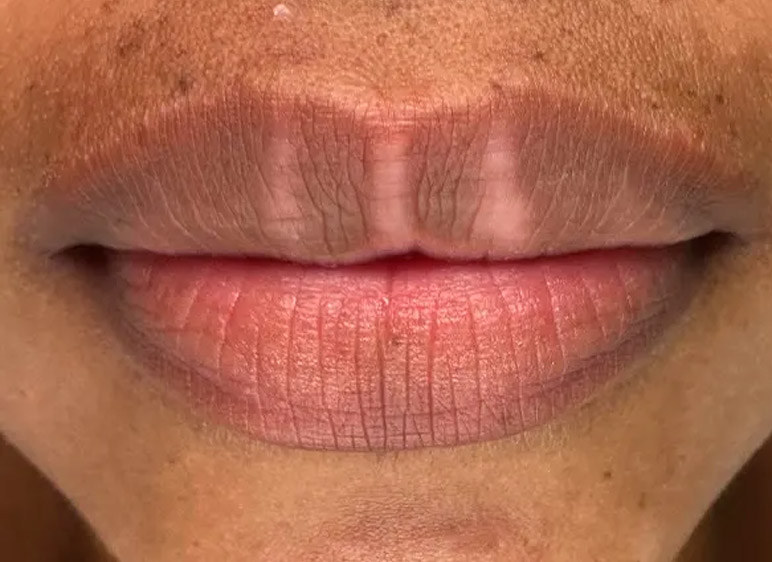 Remoción química de labios