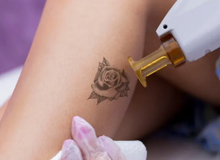 Eliminar Tatuajes - Dani Osorio Studio