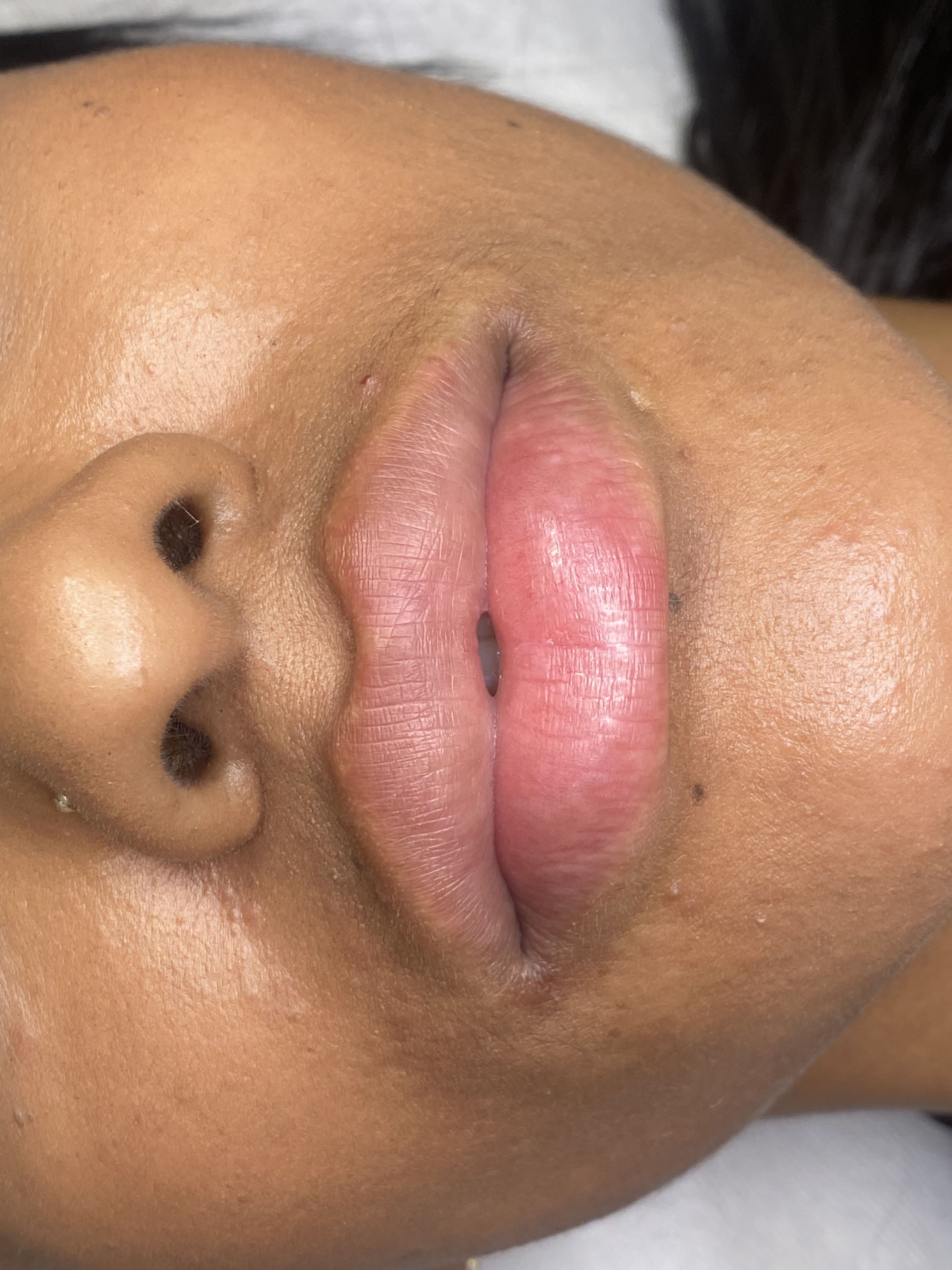 Neutralización labios 1