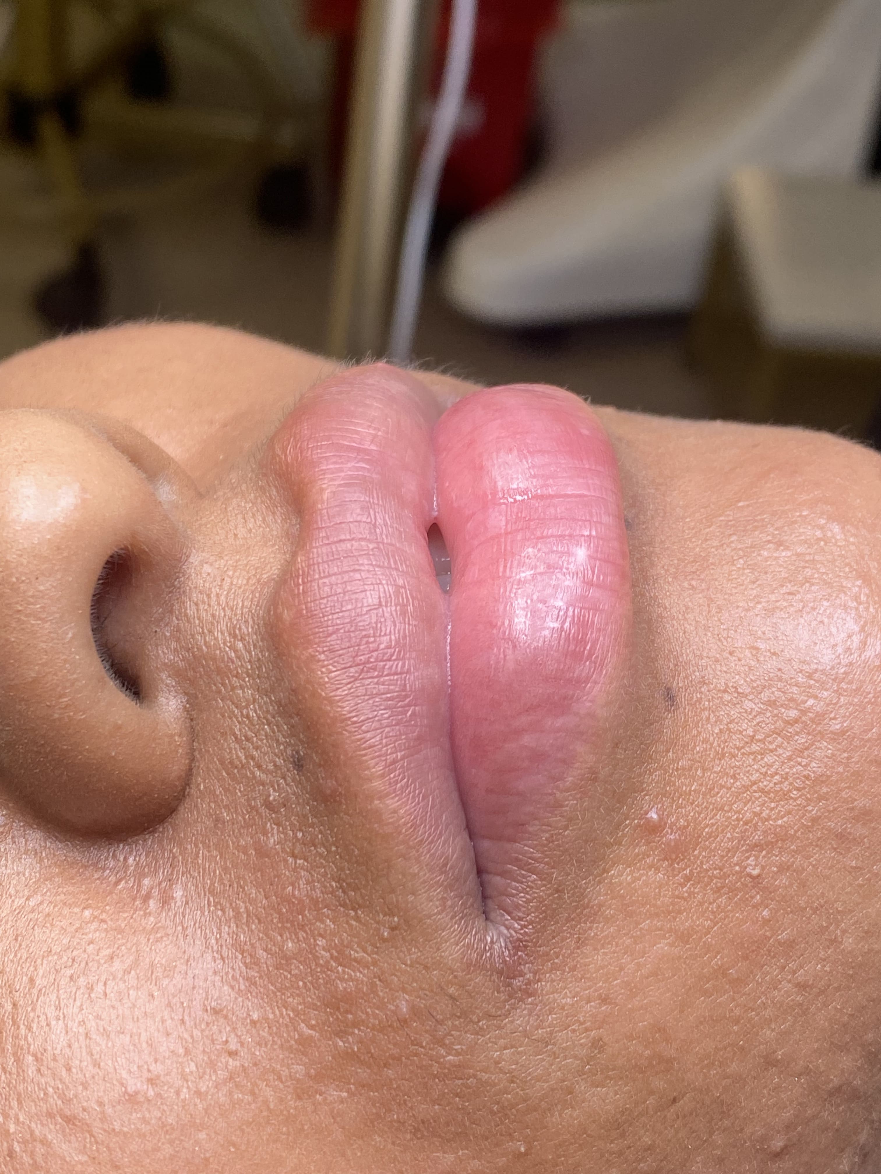 Neutralización labios 2