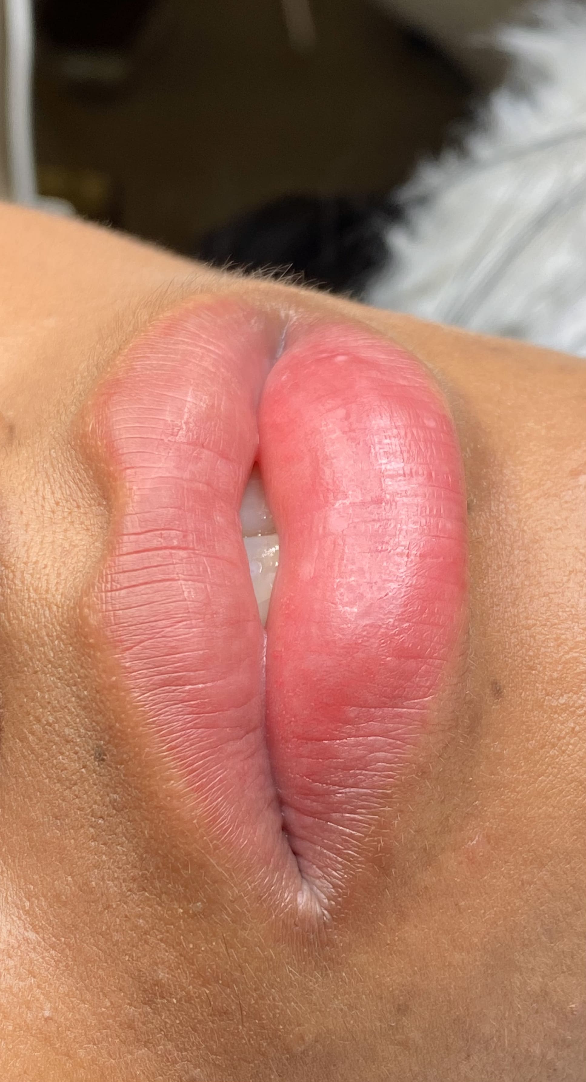 Neutralización labios 3