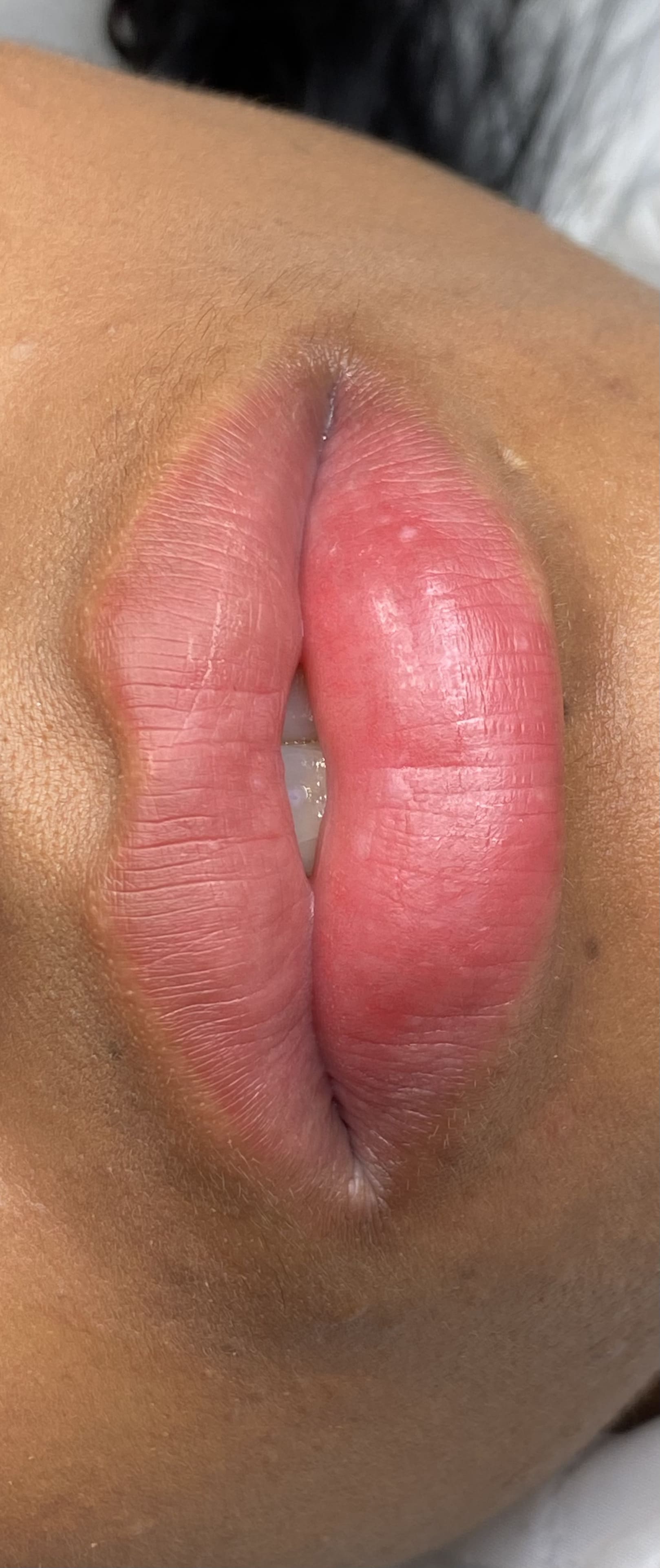 Neutralización labios 4