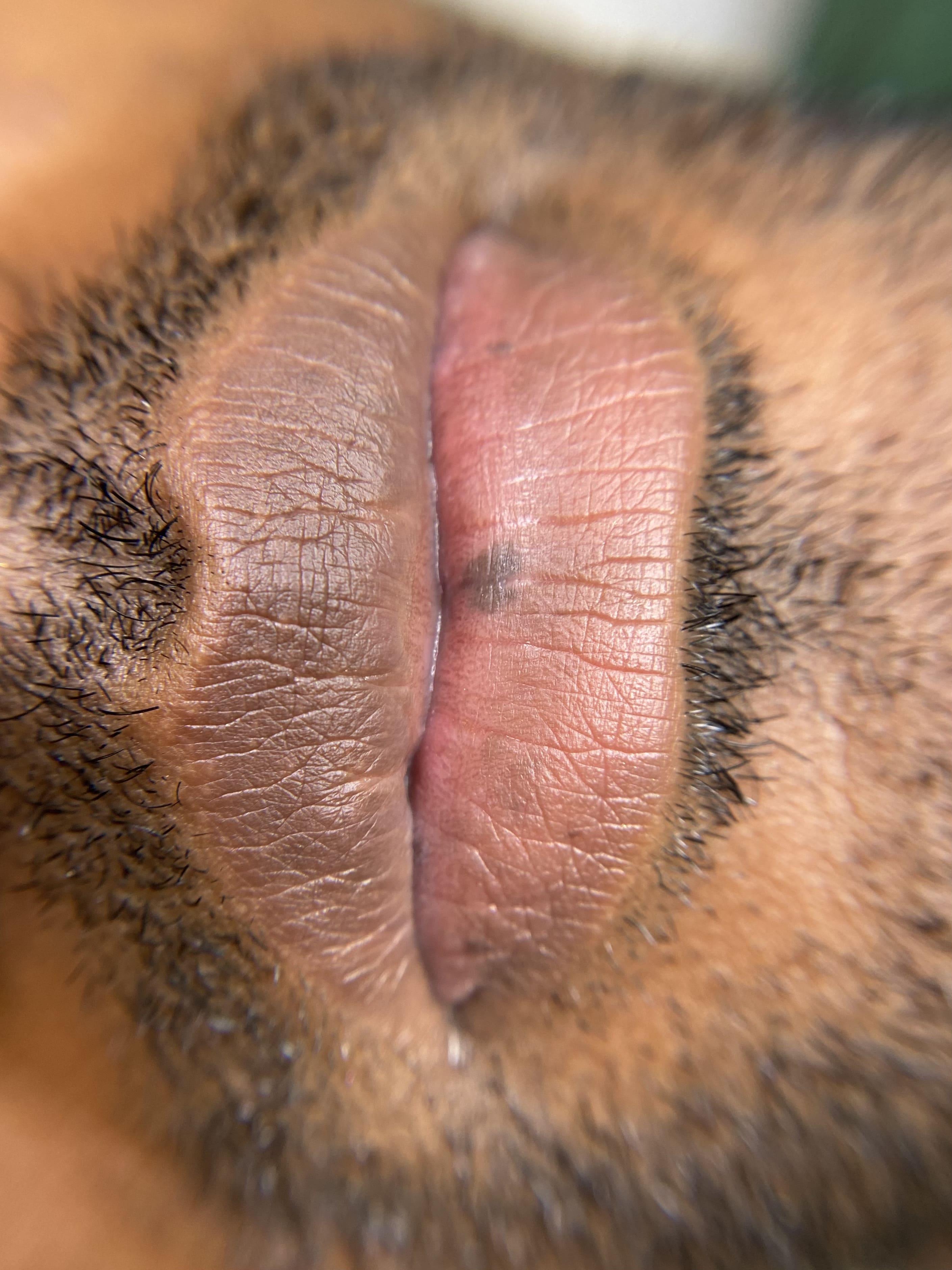 Neutralización labios 7