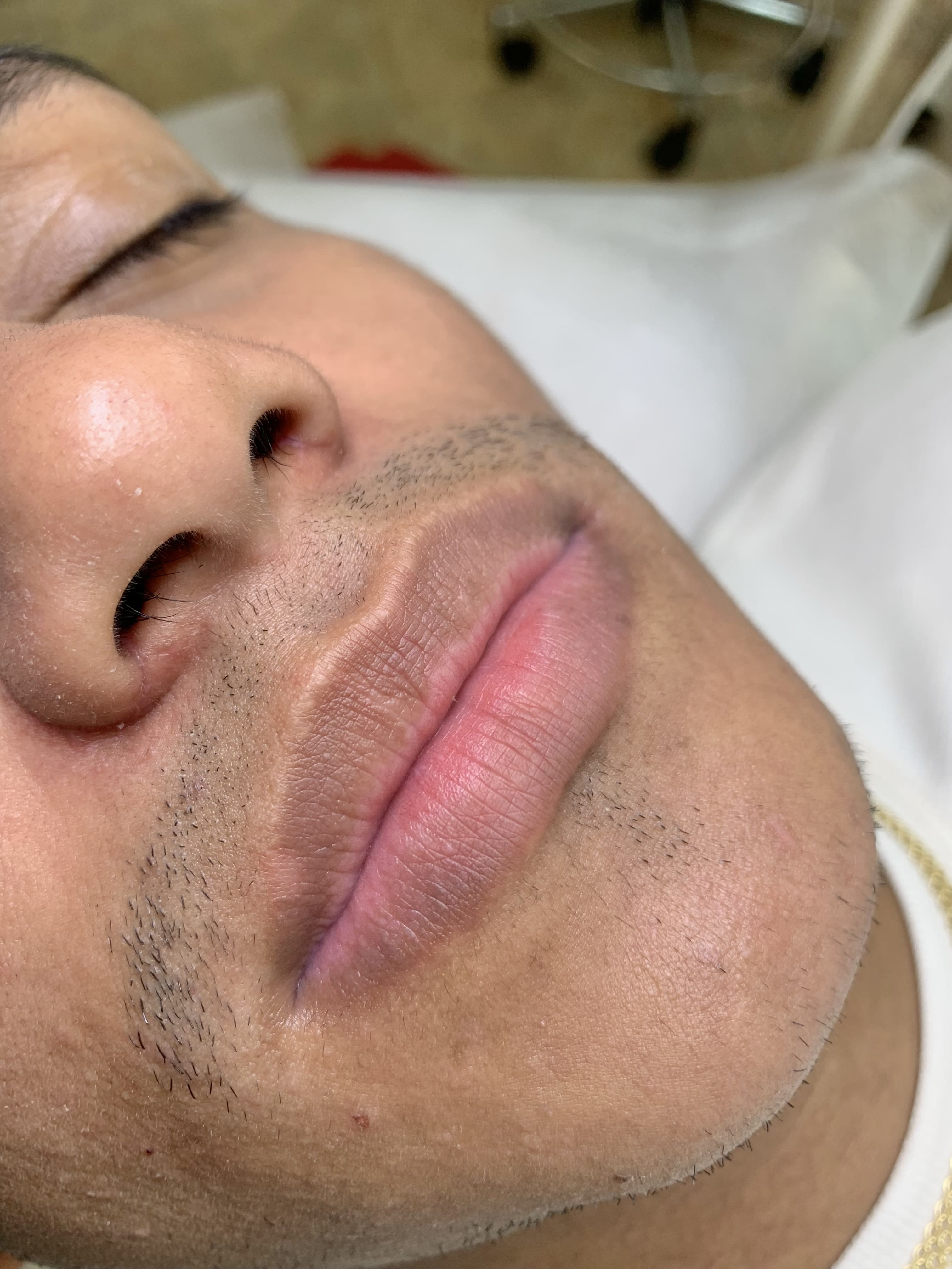 Revitalización labios masculinos 1