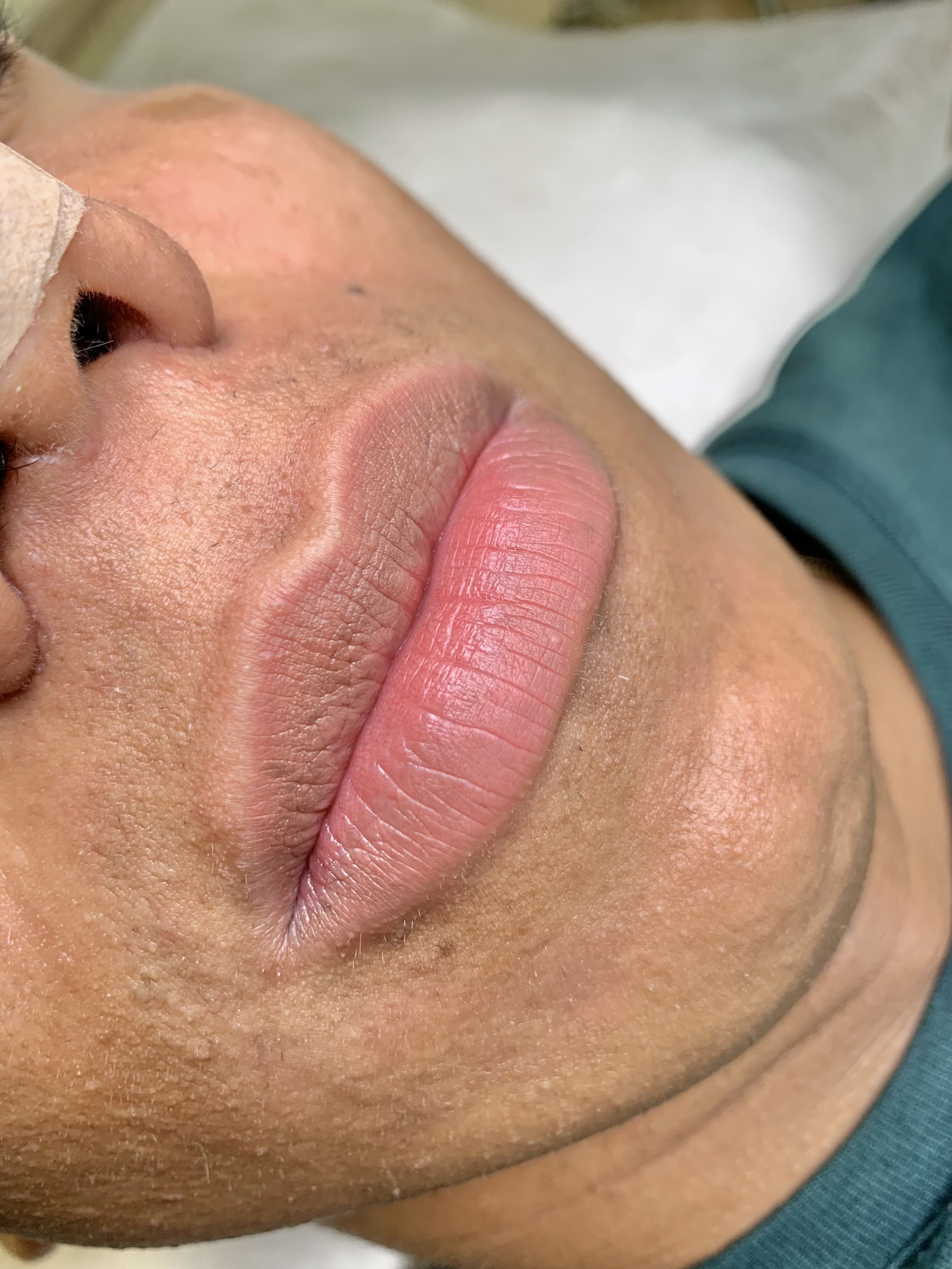 Revitalización labios masculinos 2