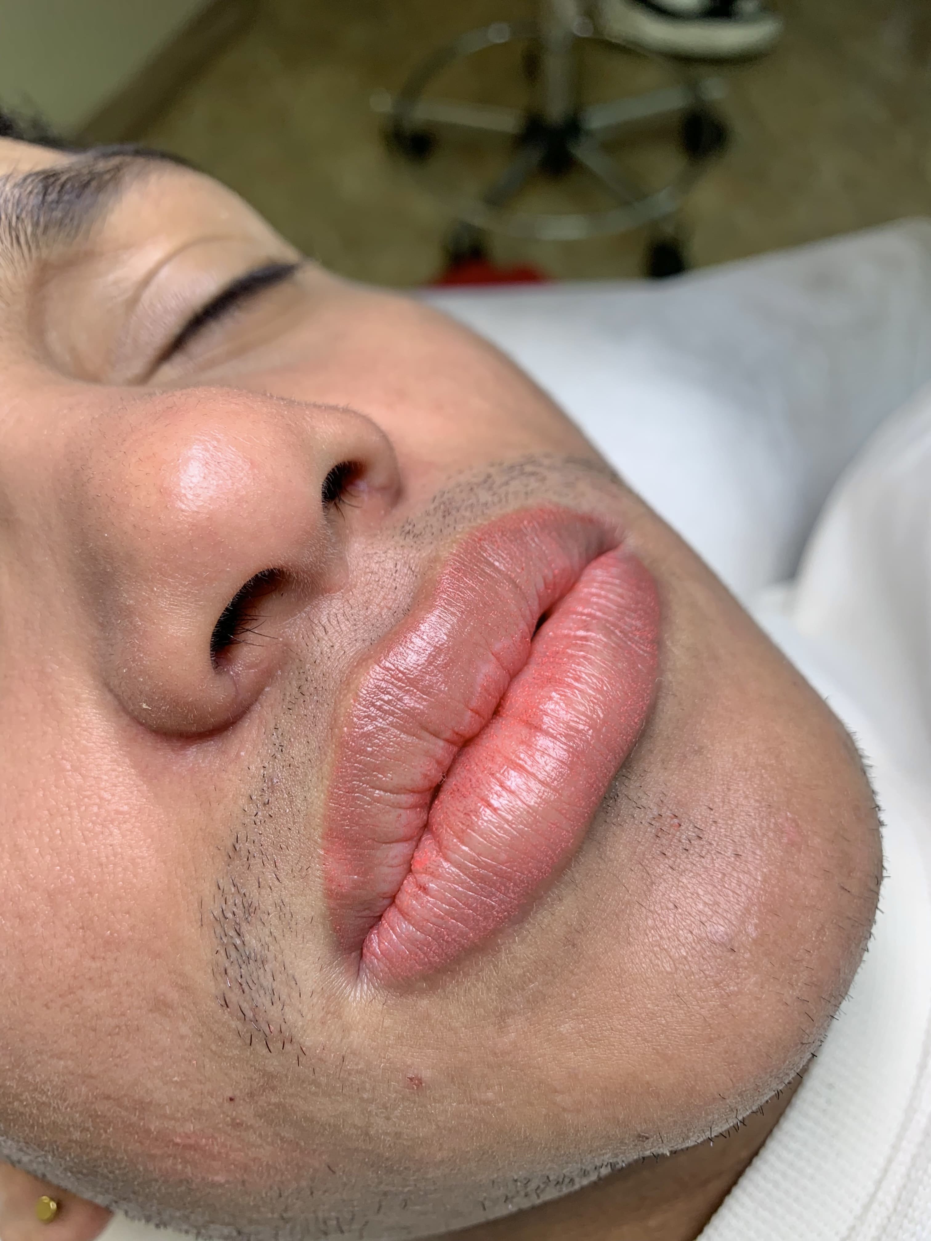 Revitalización labios masculinos 3