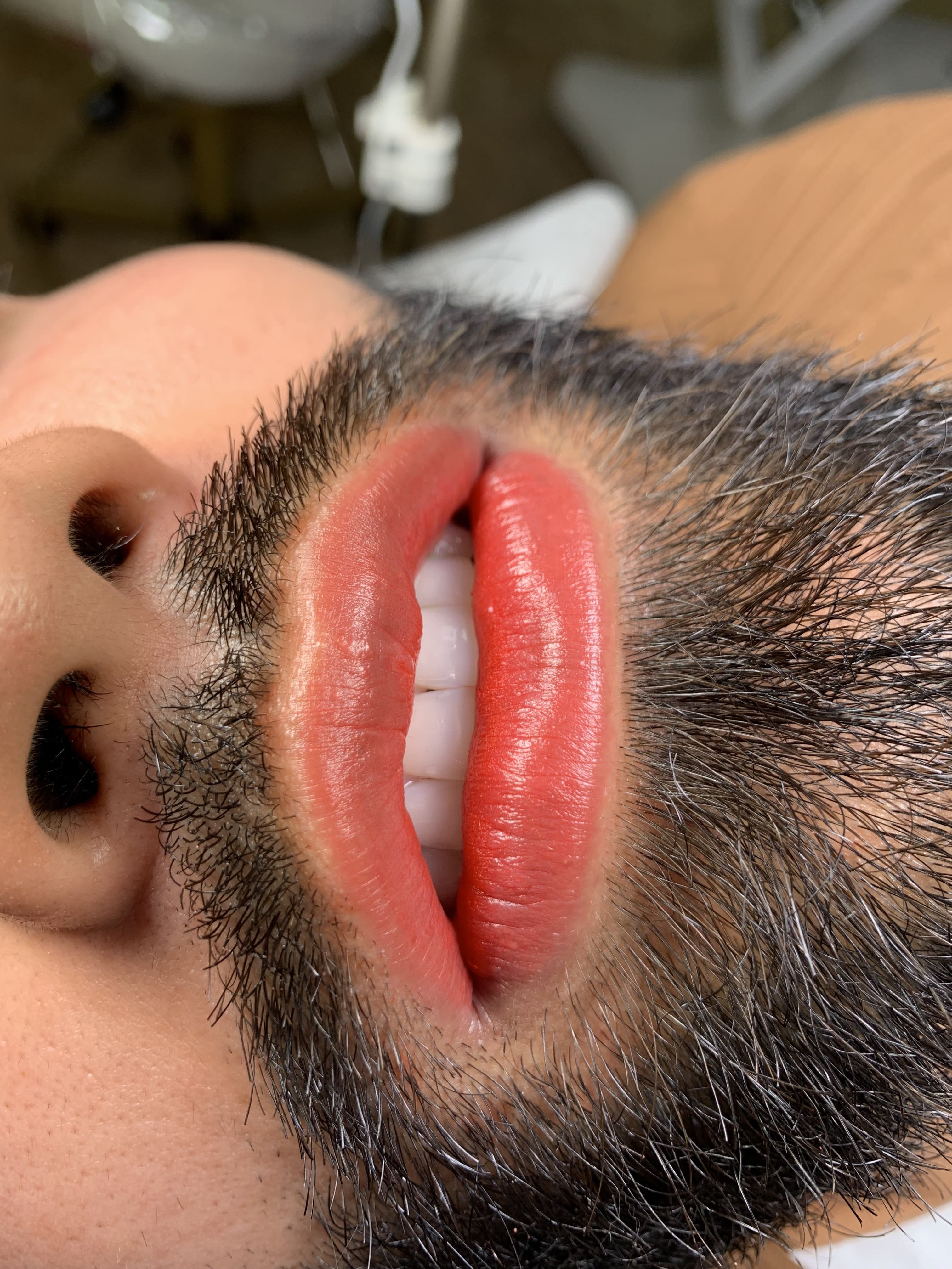 Revitalización labios masculinos 6