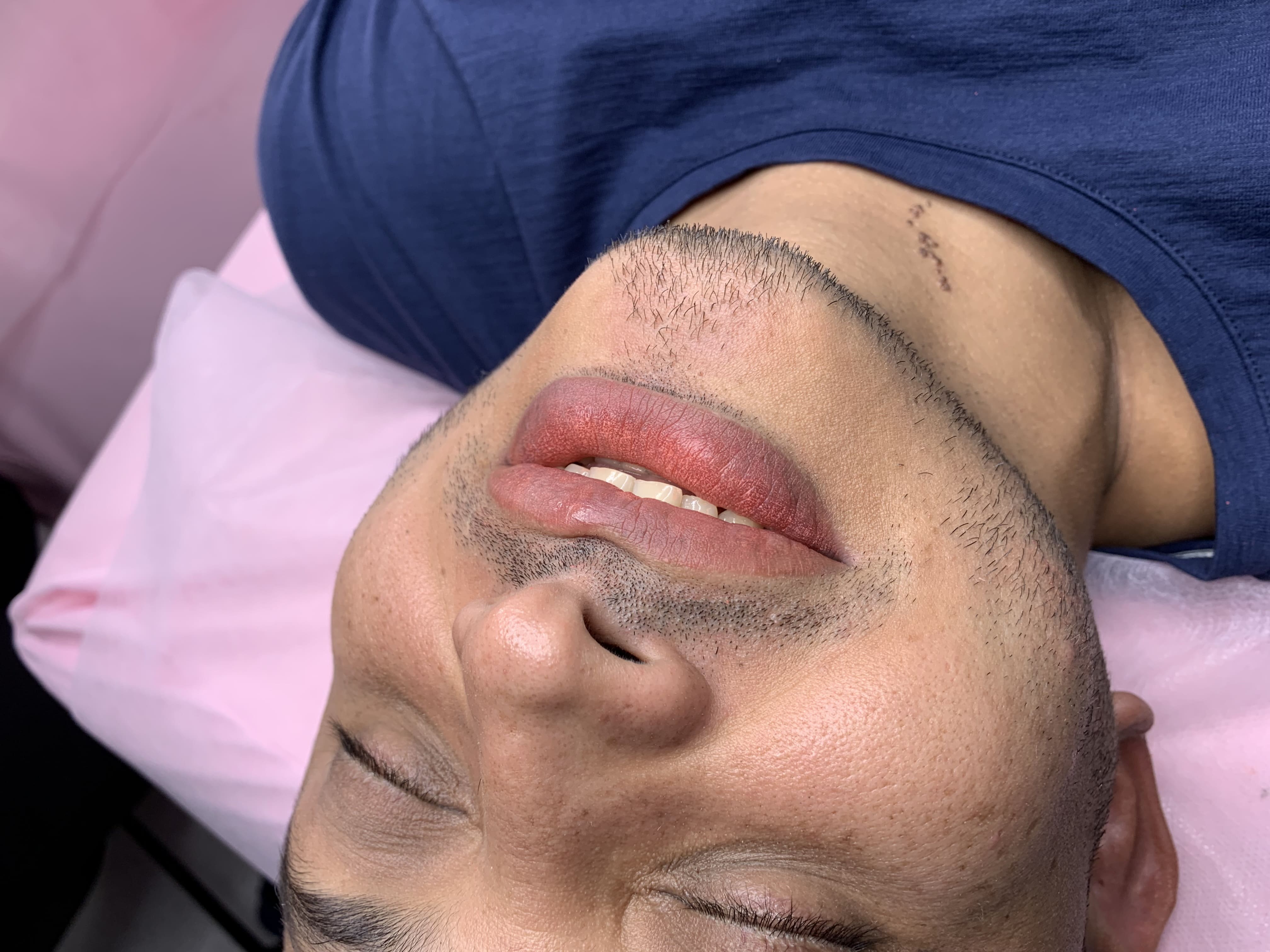 Revitalización labios masculinos 8